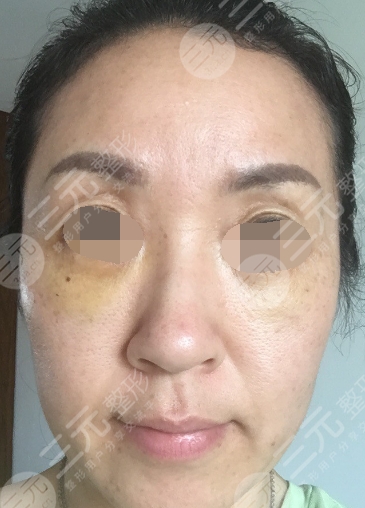 面部年輕化plus全臉，快速解決面部問(wèn)題，內(nèi)附真實(shí)案例分享圖