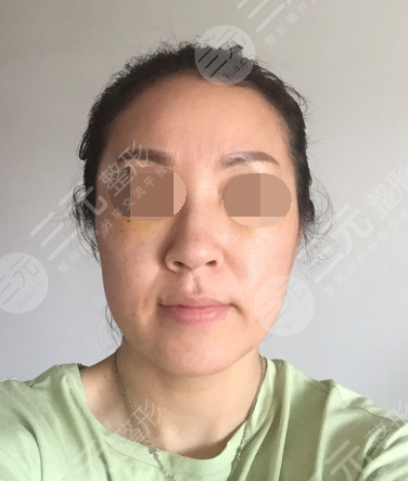 面部年輕化plus全臉，快速解決面部問(wèn)題，內(nèi)附真實(shí)案例分享圖