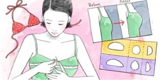 北京假體隆胸真人案例大分享,豐胸果看得見