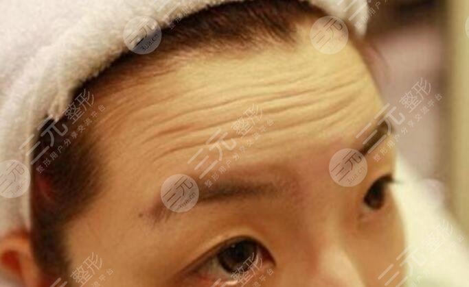 去抬頭紋大概要多少錢？深知4個(gè)原因影響了手術(shù)的價(jià)格！