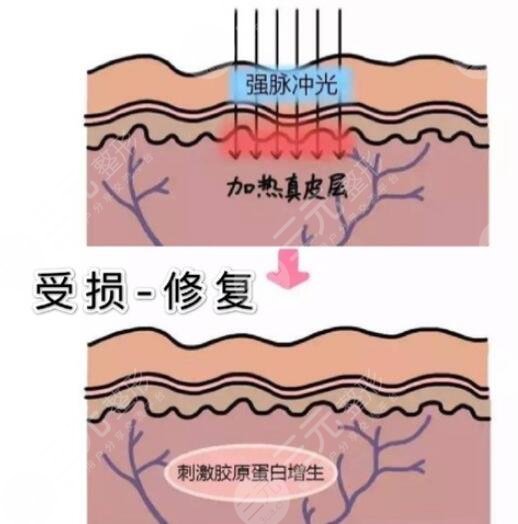 復合彩光嫩膚原理