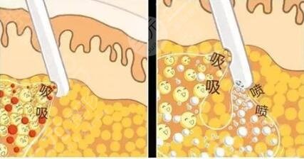 什么是臂部吸脂手術(shù)