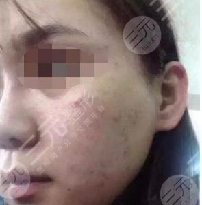 真人果酸換膚后一個(gè)月