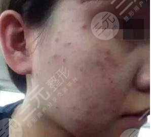 真人果酸換膚前