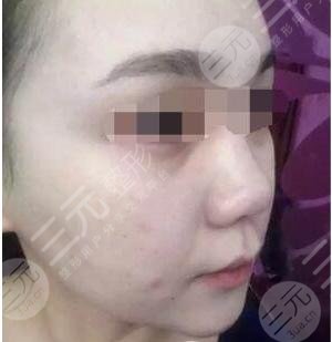 真人果酸換膚后2個(gè)月