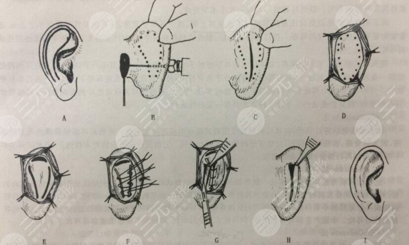 顱耳角在30°-60°之間是一種天生畸形，矯正方法如下