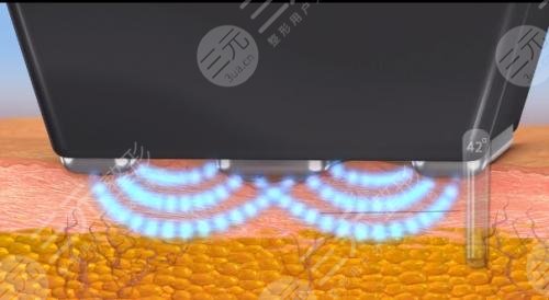 鉆石超塑爆脂費用