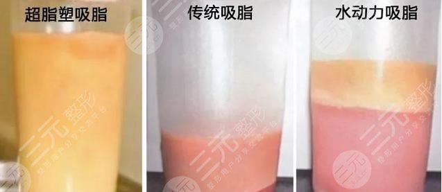 與普通吸脂有什么區(qū)別