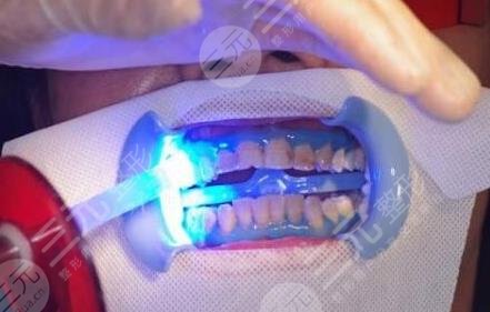 成都舒雅口腔醫(yī)院牙齒冷光美白案例分享