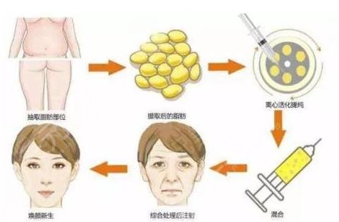 脂肪填充多久能恢復？填充臉部需要多少錢？附價格表+相關介紹