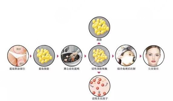 脂肪填充多久恢復