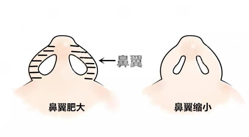 鼻翼太寬怎么整形？鼻翼縮小手術(shù)怎么樣？附鼻部整形價(jià)格表