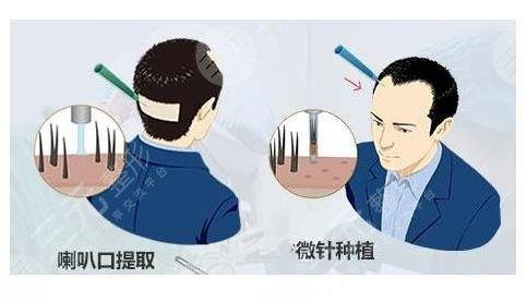 蘭州植發(fā)醫(yī)院發(fā)際線種植相關(guān)問(wèn)題介紹