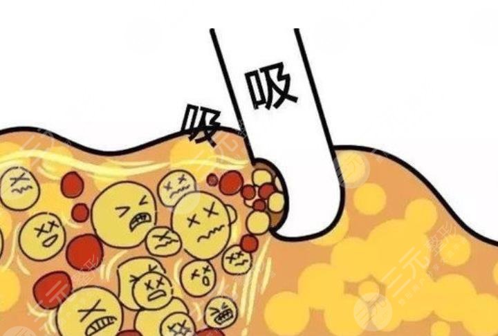 瘦身欄目|超脂塑吸脂有沒有副作用？來看看哪些人不適合做！