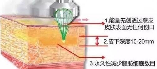 超脂塑術(shù)后恢復(fù)期是多久?