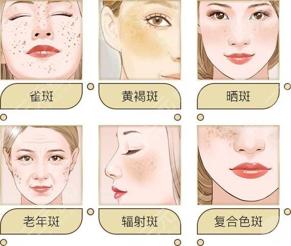 301醫(yī)院激光美容科激光去黃褐斑相關問答：黃褐斑是什么？