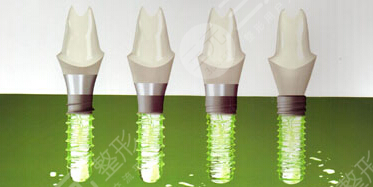 瑞士種植體iti三種檔次