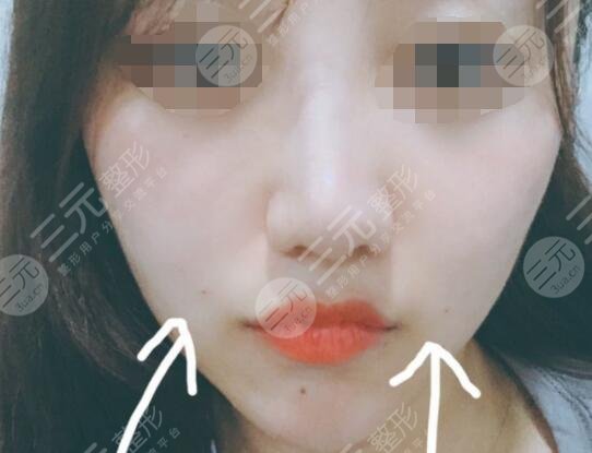 真人體驗激光除皺后