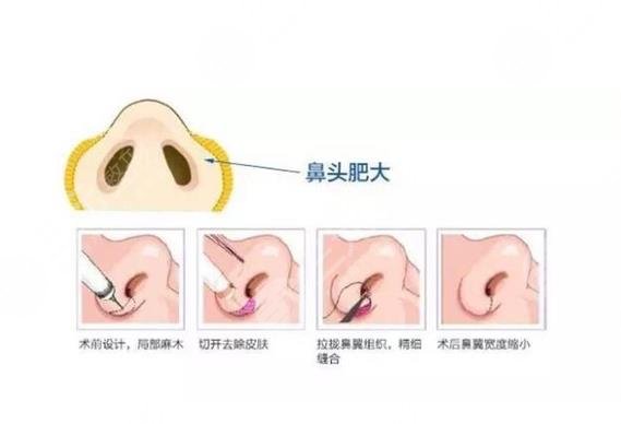 影響鼻翼縮小手術(shù)價格的因素
