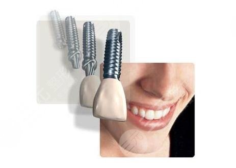 上海種植牙一顆多少錢明細