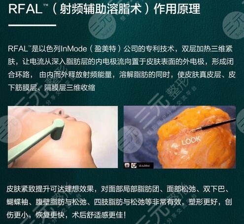 雙下巴吸脂多少錢