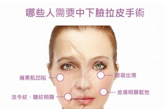 科普|中面部拉皮手術(shù)切口在哪兒？費用是多少？一個月消腫是真的嗎？