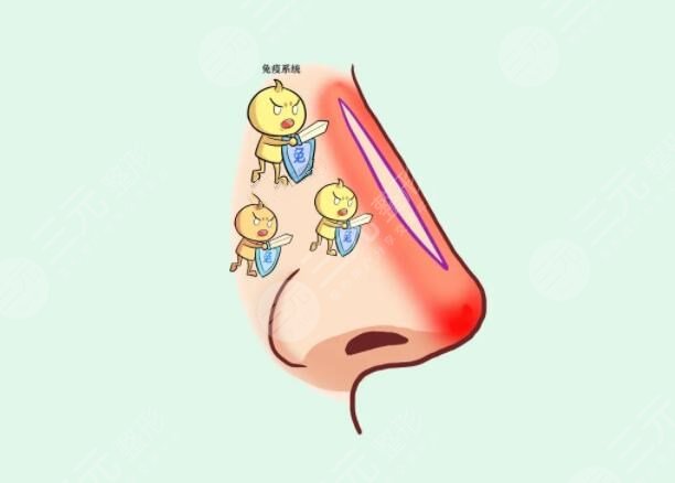 自體軟骨隆鼻的維持時間是多久