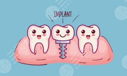 全口種植牙的利與弊你了解么？種植牙的維持時間，帶你仔細的了解！