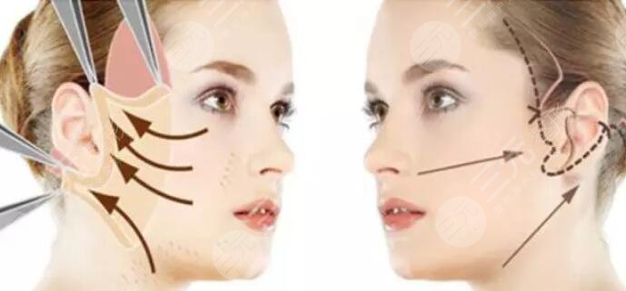 微創(chuàng)拉皮手術(shù)成好嗎？能維持幾年？微創(chuàng)拉皮手術(shù)的注意事項需掌握！