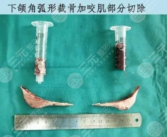磨骨手術(shù)在緩解之后需要注意什么呢