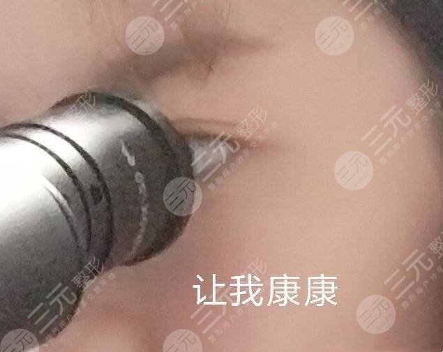 廈門海峽張宏做雙眼皮如何？