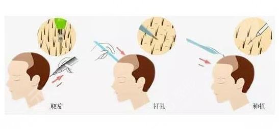 植發(fā)醫(yī)療項(xiàng)目介紹之頭發(fā)種植手術(shù)問(wèn)答科普