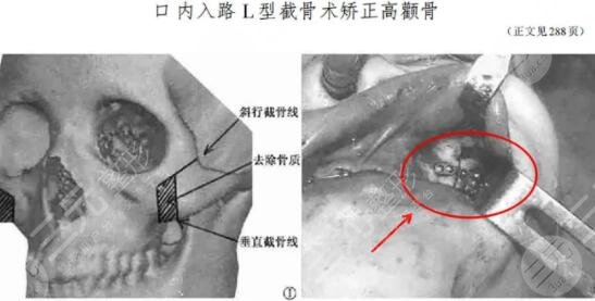 顴骨整形術(shù)的疼痛感