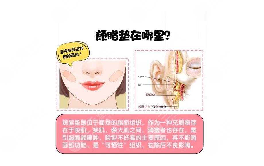頰脂墊在哪個(gè)部位?去掉頰脂墊有什么危害?術(shù)前準(zhǔn)備+術(shù)后護(hù)理~