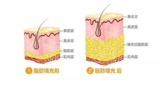 填充額頭多少錢(qián)？玻尿酸or自體脂肪？一文詳解豐額頭的秘籍，馬??！