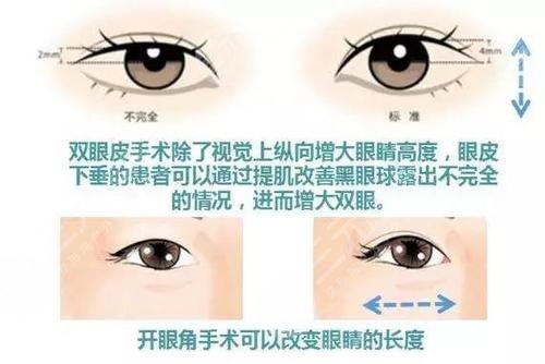 開眼角對比果圖文講解！前后區(qū)別一覽，康康你是否需要do一下！