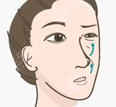 韓式生科二段隆鼻術(shù)后果圖，屌絲變男神