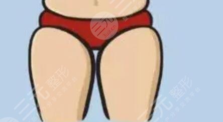 大腿吸脂減肥后恢復(fù)過程_真實(shí)案例分享