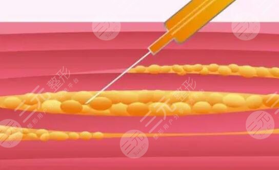 大腿吸脂減肥后恢復(fù)過程_真實(shí)案例分享