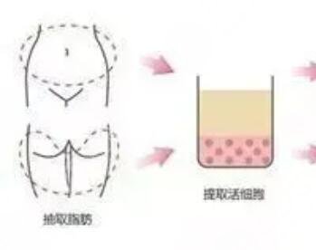 成都天之美整形好嗎？自體填充變美日記傾情分享