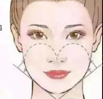 成都天之美整形好嗎？自體填充變美日記傾情分享