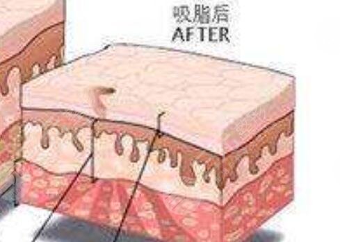 歐洲之星溶脂瘦肚子:術(shù)后第7天