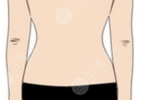 超脂塑溶脂術(shù)后會(huì)出現(xiàn)凹凸不平的現(xiàn)象嗎