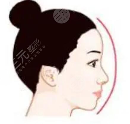 廈門華美謝常禮隆鼻案例