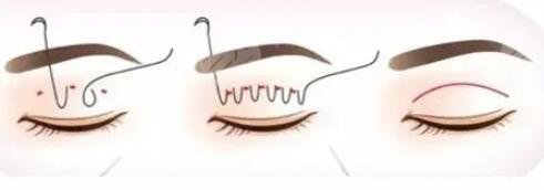 全切雙眼皮40天恢復(fù)圖