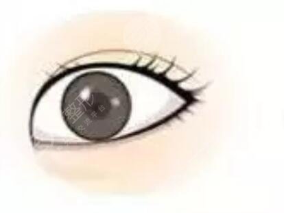 全切雙眼皮40天恢復(fù)圖