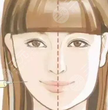 雙眼皮術(shù)后一個月