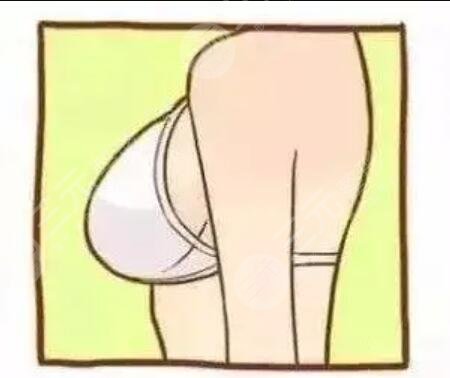 取出假體隆胸后胸部是不是會特別丑?