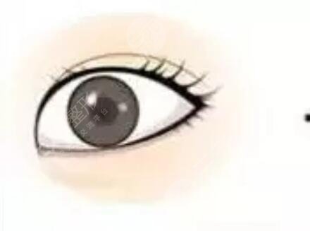 成都八大處胡瓊華雙眼皮手術術后第24天