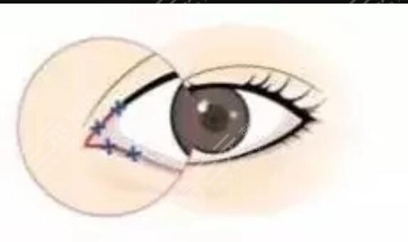 成都八大處胡瓊華雙眼皮手術術后第24天